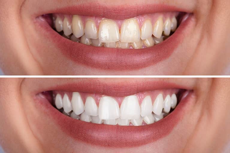 Is Composite Bonding Worth It? A Dentist's Honest Pros and Cons
