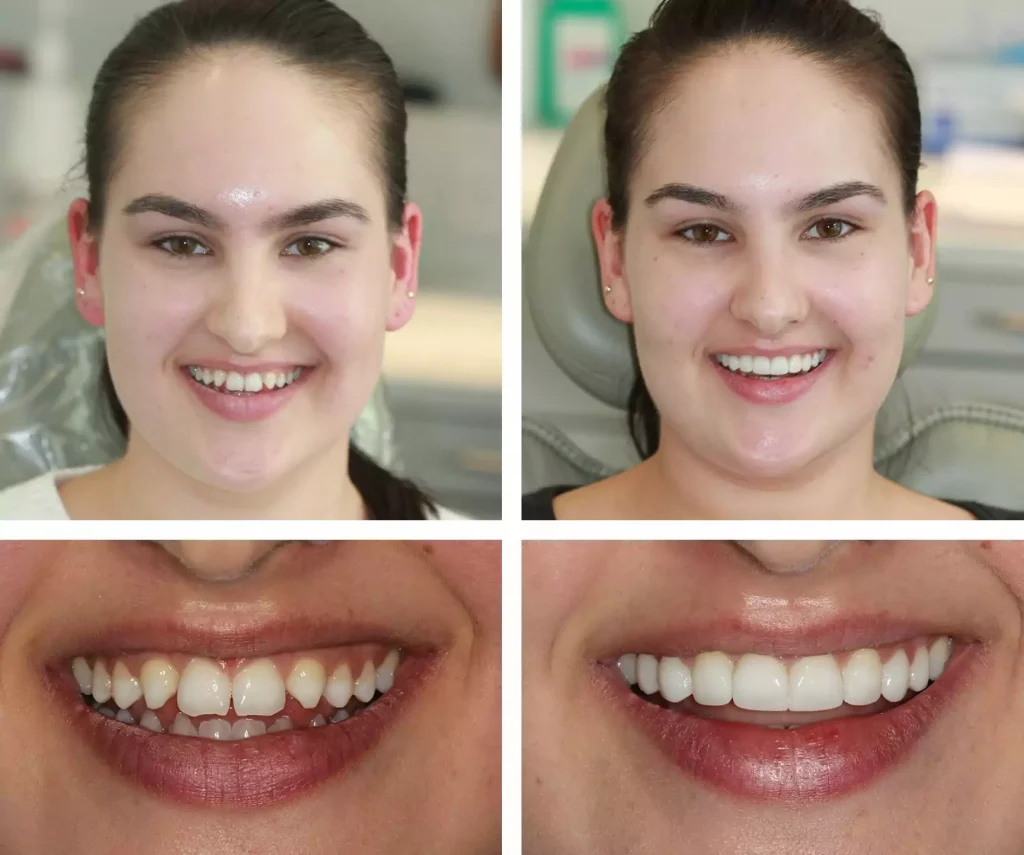 composite bonding at Eccleshill Dental in Bradford